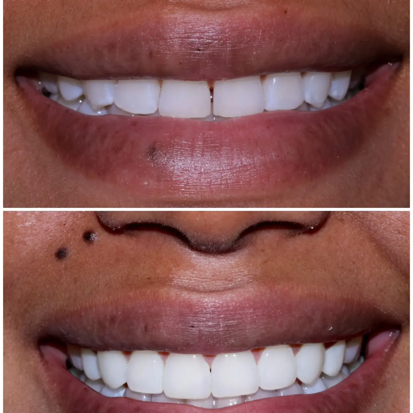 Comparación de sonrisas en el caso de carillas dentales